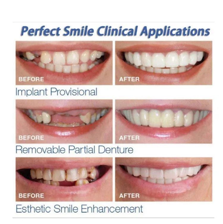 Carillas Snapon Smile