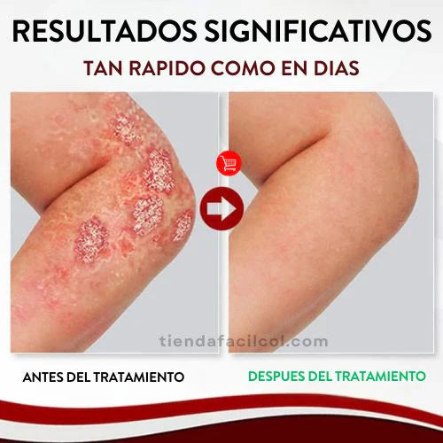 1 Spray Eliminación Psoriasis
